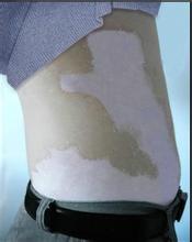 邯郸哪家医院可以治疗腰部白癜风