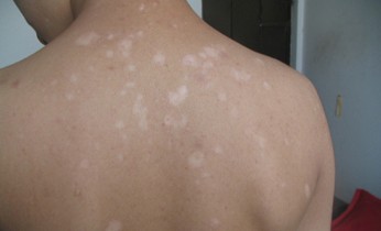 张家口能治好白癜风吗