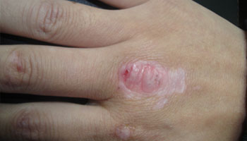 邢台激光治疗白癜风会复发吗