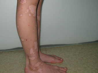 沧州白癜风不及时治疗会怎样