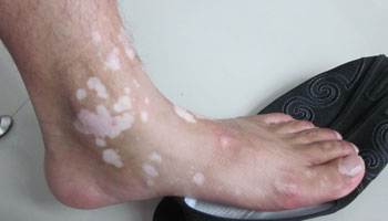 张家口脖子上长了一块白斑是怎么回事