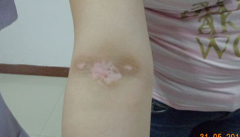 手臂上的白癜风JPG