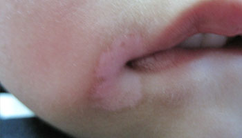 早期儿童白癜风