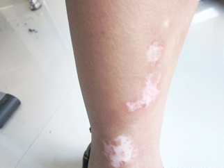 宋同学12岁右小腿白斑6年