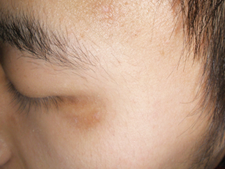 【治疗前,面部白斑色素脱失严重,面积较大】【康复过程】▲治疗:首先