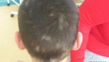 小孩头上的白发能否药物治疗吗