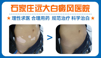 小孩肚子有白癜风白斑邢台哪家医院可以治疗呢