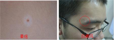 天津晕痣型白癜风哪家医院治的好呢