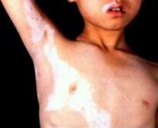 儿童白癜风吃药能治好白癜风吗