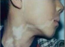 天津白癜风医院是怎么治泛发型白癜风的