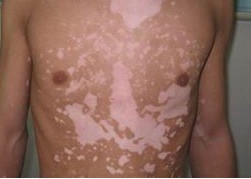 邢台治疗白癜风应该去哪家医院