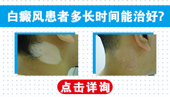 邯郸白癜风患者能长期吃药治疗吗