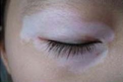 女性会患上毛囊型白癜风吗