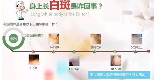 男性腿部白癜风一般有哪些症状