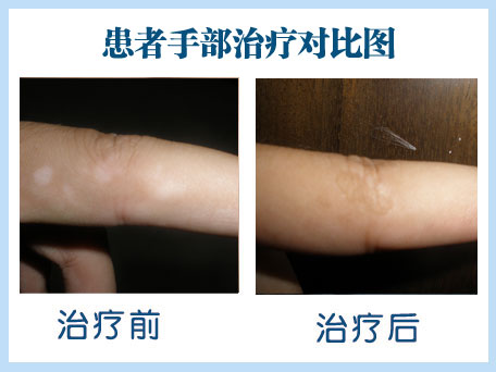 天津白癜风医院哪家效果呢