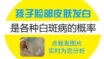 进展期白癜风如何正确治疗