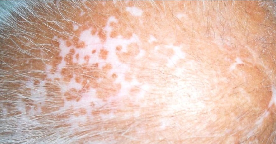 沧州额头上的白癜风哪种治疗方式好