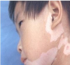 沧州白癜风的好医院在哪