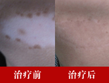廊坊哪家医院能够治疗青少年腿部白癜风