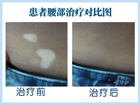 天津哪家医院有308纳米激光治疗仪