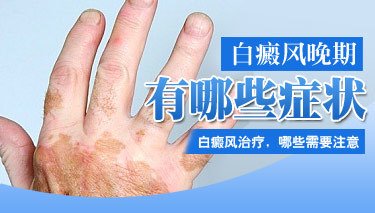 出现散发型白癜风该怎样治疗