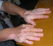 夏季白癜风患者可以进行中医治疗吗