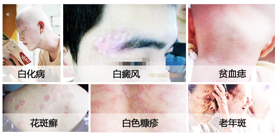 <strong>  皮肤有白斑or隐形白斑，你来免费查</strong>