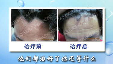 石家庄哪家白癜风医院的手术做的好