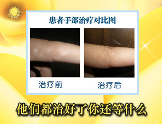 散发型白癜风的发病原因是什么