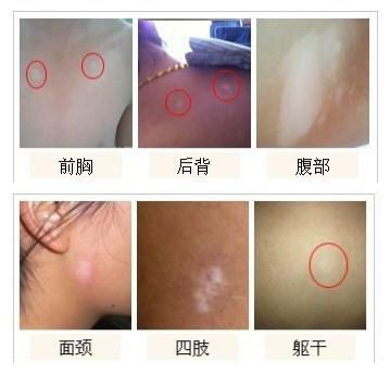 石家庄哪家专科医院治局限型白癜风好呢