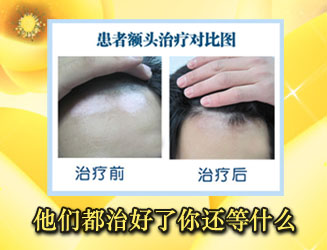 工作期间白癜风该如何治疗