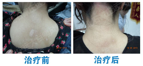 石家庄预防白斑的措施都是什么