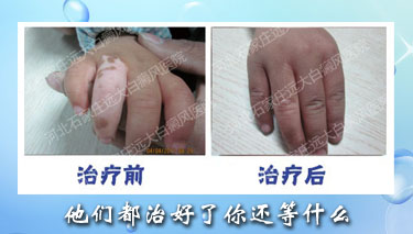 手部白癜风.jpg