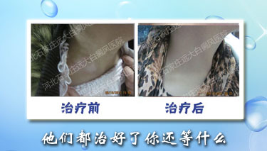 健康的生活方式利于白癜风治疗