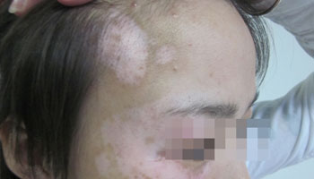 石家庄治疗头部白癜风的医院