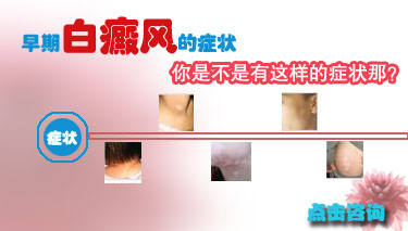 生完孩子背后长了白癜风好治吗