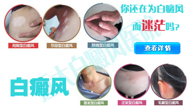 夏季治疗白癜风的秘方有哪些