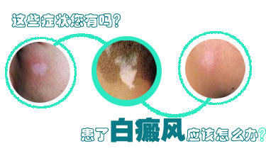 药物治疗白癜风会不会影响生育吗