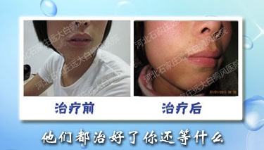 治疗腿部白斑要忌讳什么