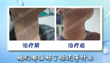 治疗白癜风的中医方法有哪些