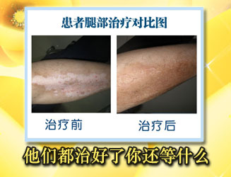 邯郸哪家医院能够治疗的好白癜风