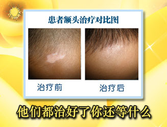 白癜风有一个月治好的吗