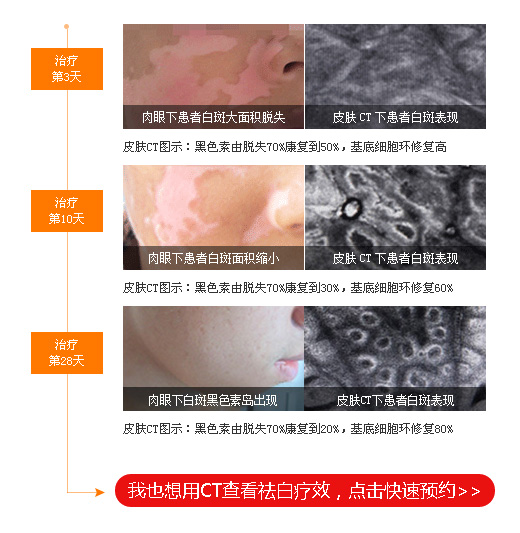 邯郸白癜风医院专科