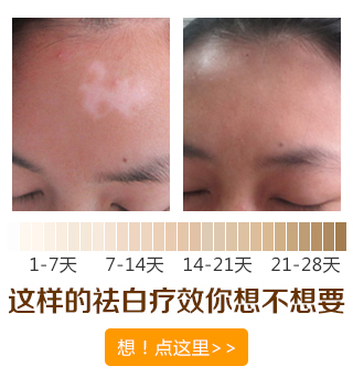 夏天来临白癜风治疗要注意