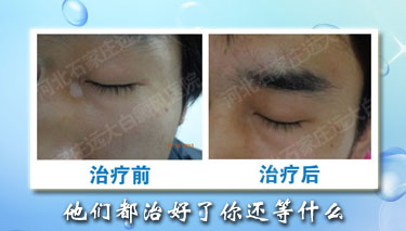 稳定期白癜风的治疗方法