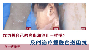 石家庄白癜风的治疗注意什么