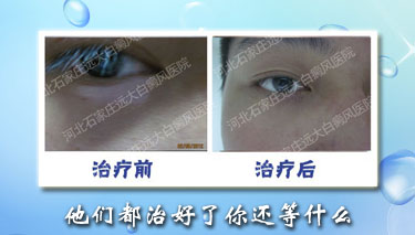 石家庄青少年的身上出现白癜风怎么办