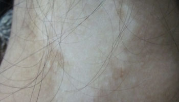 治疗毛囊型白癜风的方法有哪些