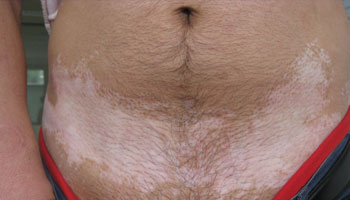 腹部白癜风如何治疗