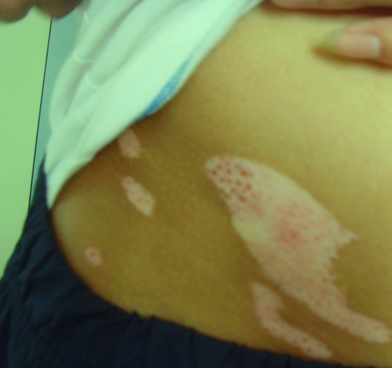 针对孕妇白癜风的治疗方法是什么